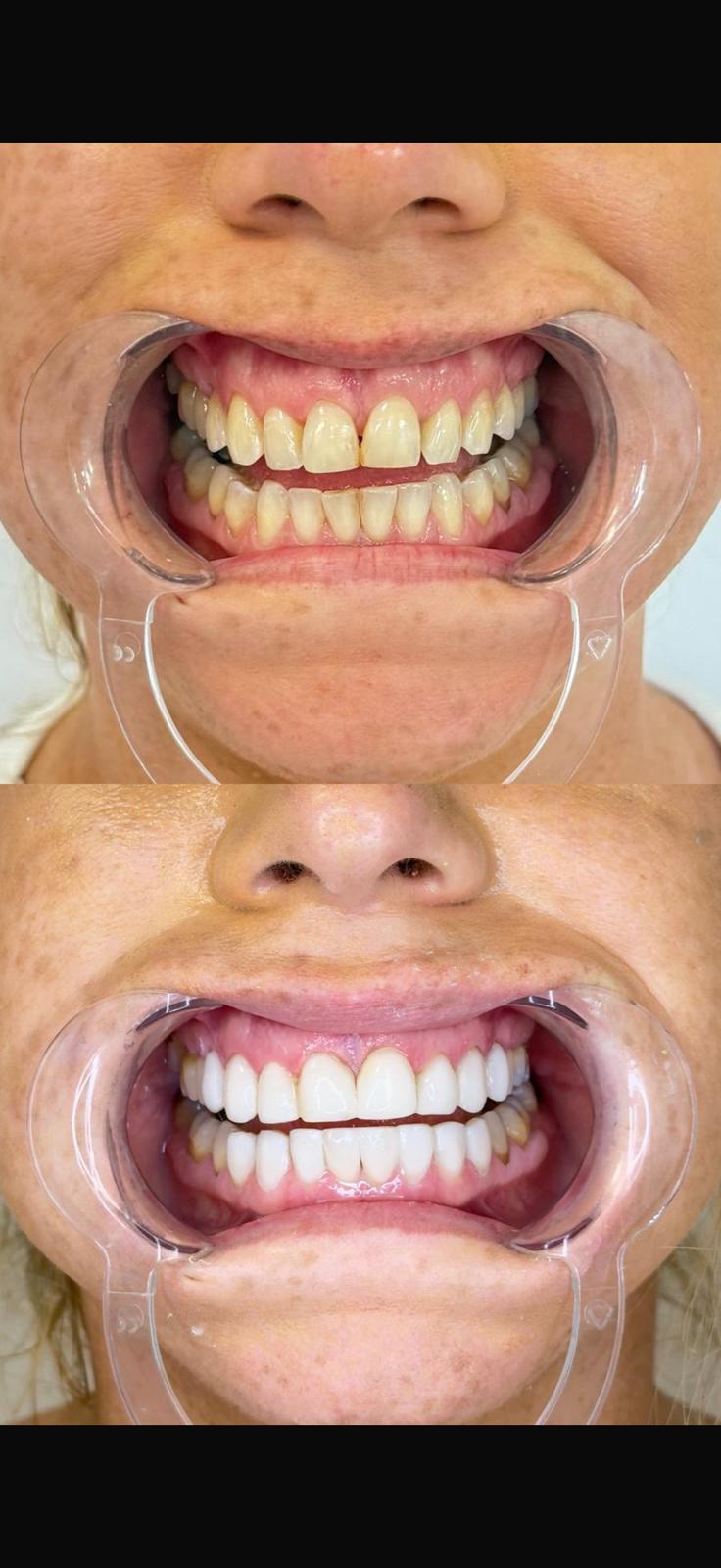 Porcelain Veneers — Gallery image 1