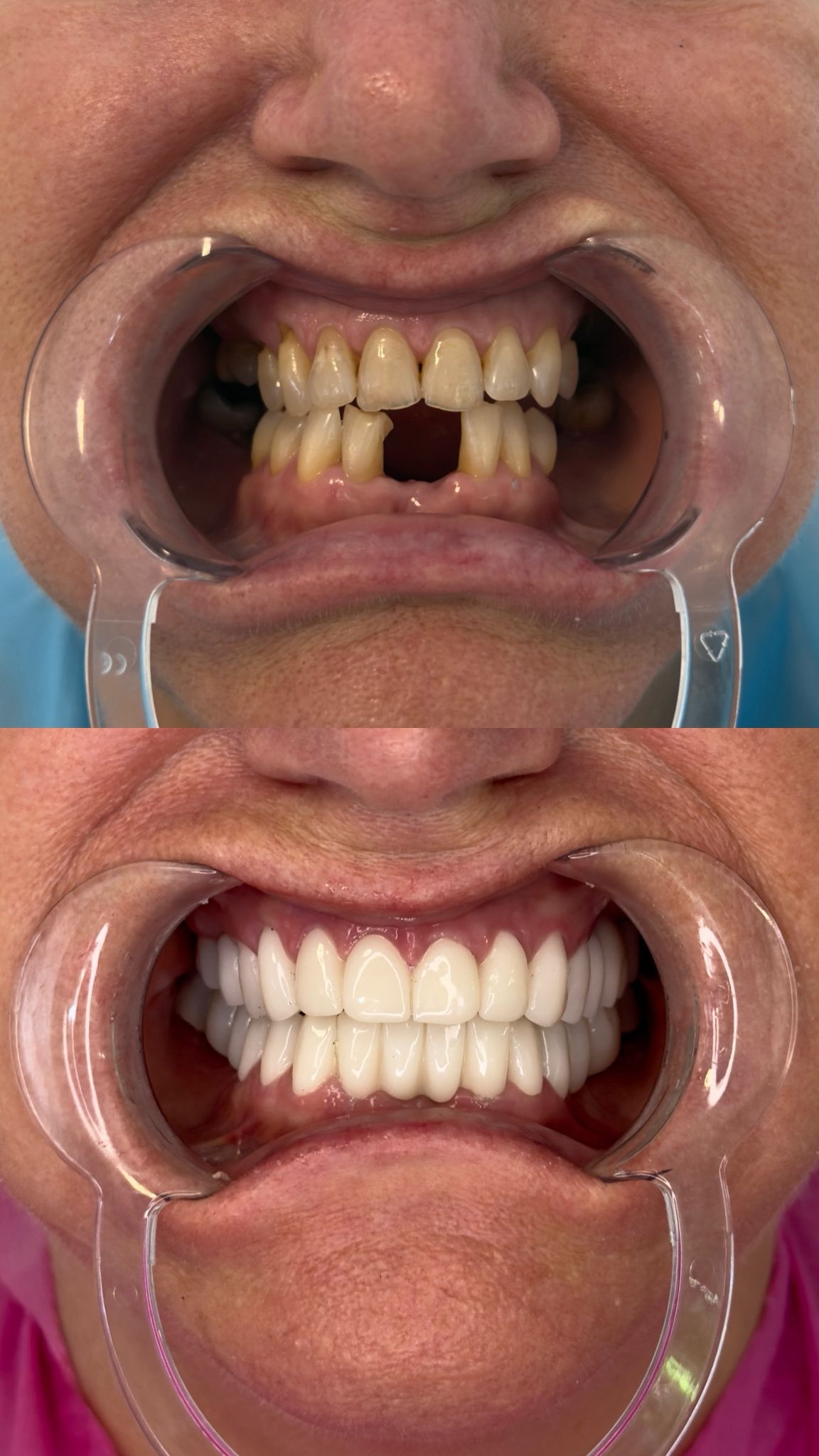 Zirconium Crowns — Gallery image 3