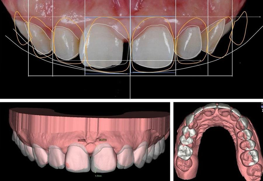 Teeth Whitening — Gallery image 3